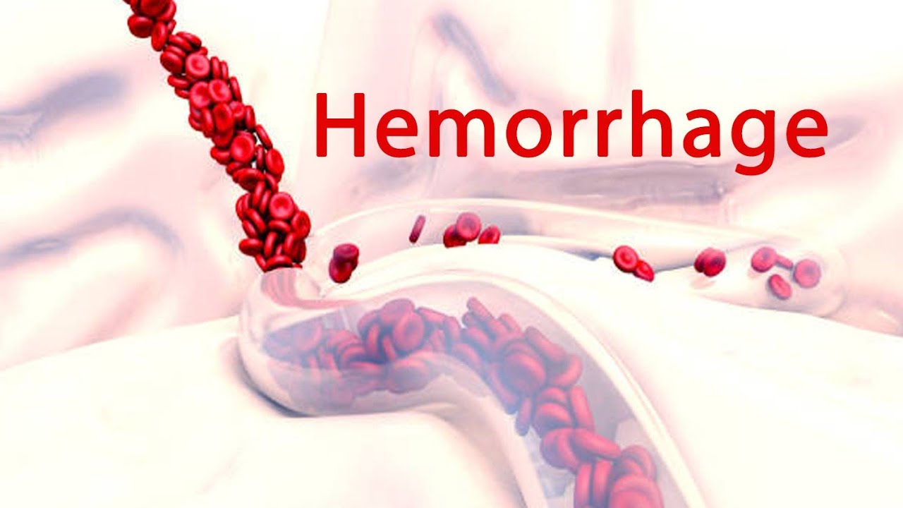 Haemorrhage 🩸 in detail only in 12min #sugery #bams4thyear #bams #haemorrhage