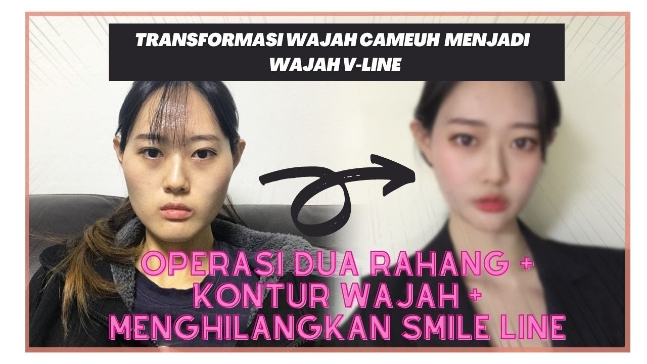 Operasi Dua Rahang + Kontur Wajah + Penghilangan Smile Line