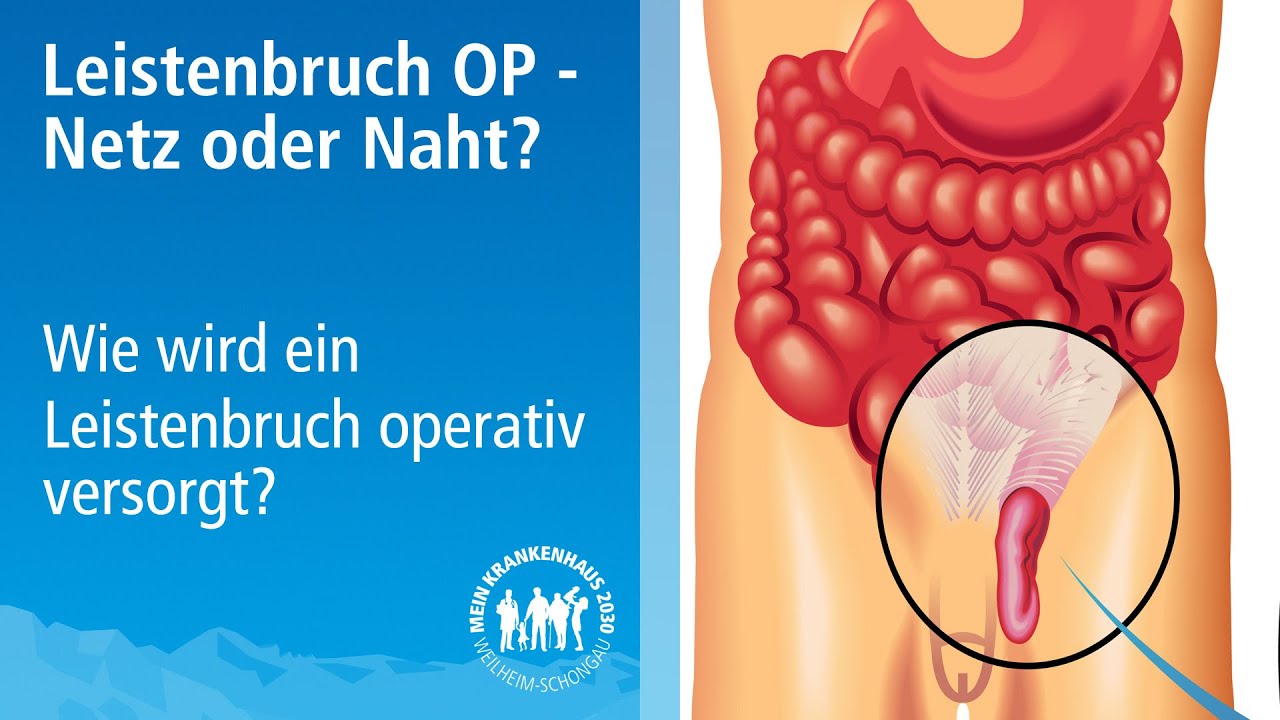 Leistenbruch Operation | Netz oder Naht ? Operative Versorgungsmöglichkeiten beim Leistenbruch