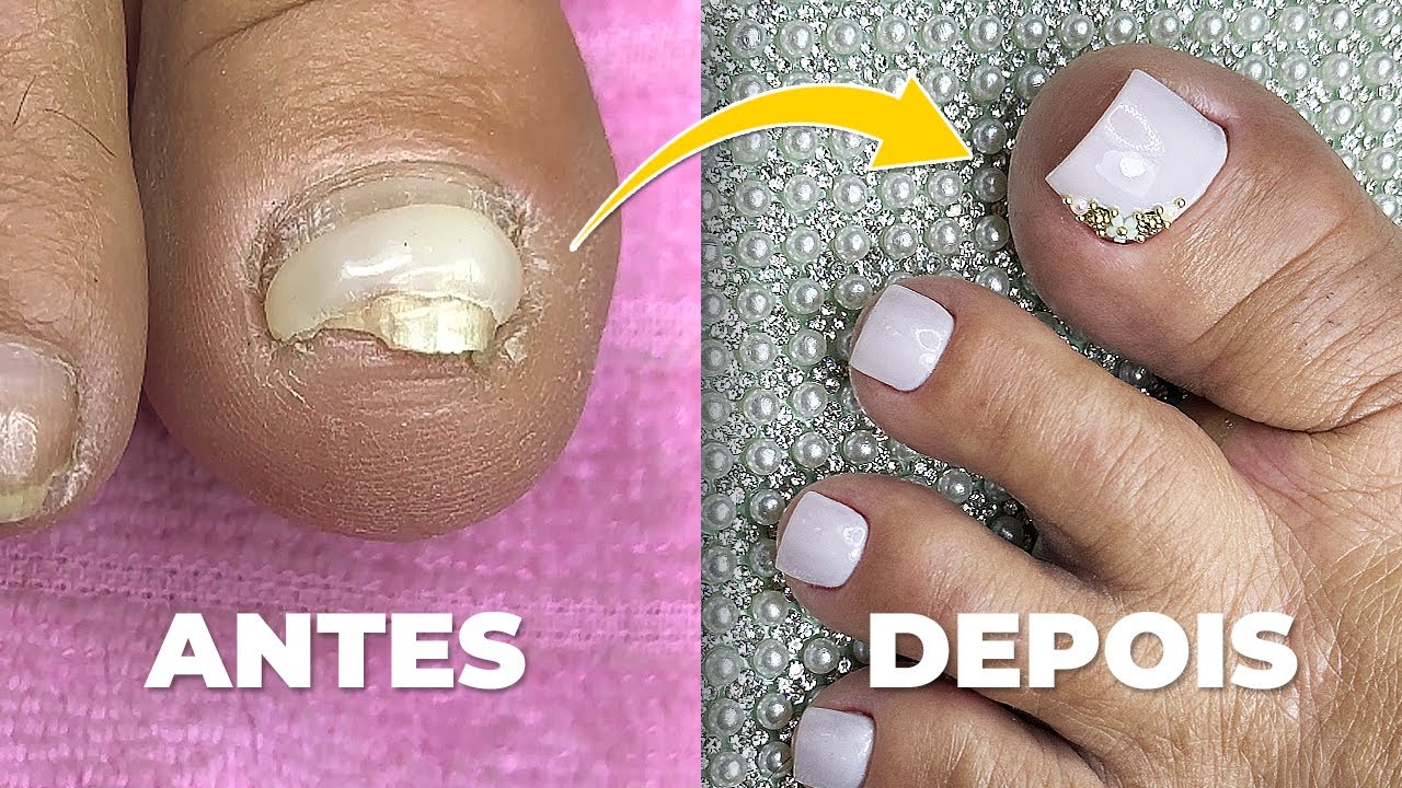 TRANSFORMAÇÃO DE UNHAS DO PÉ COMO VOCÊ NUNCA VIU (ANTES E DEPOIS)