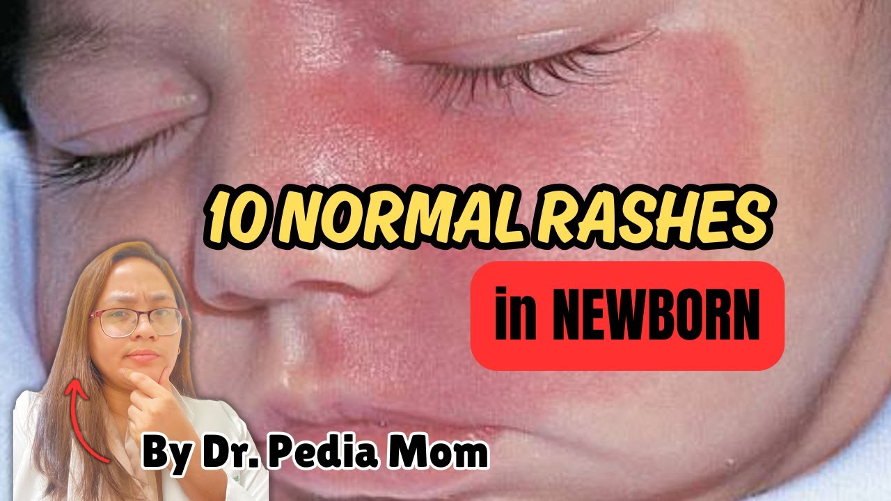 10 NORMAL RASHES na makikita sa Newborn|Dr. PediaMom