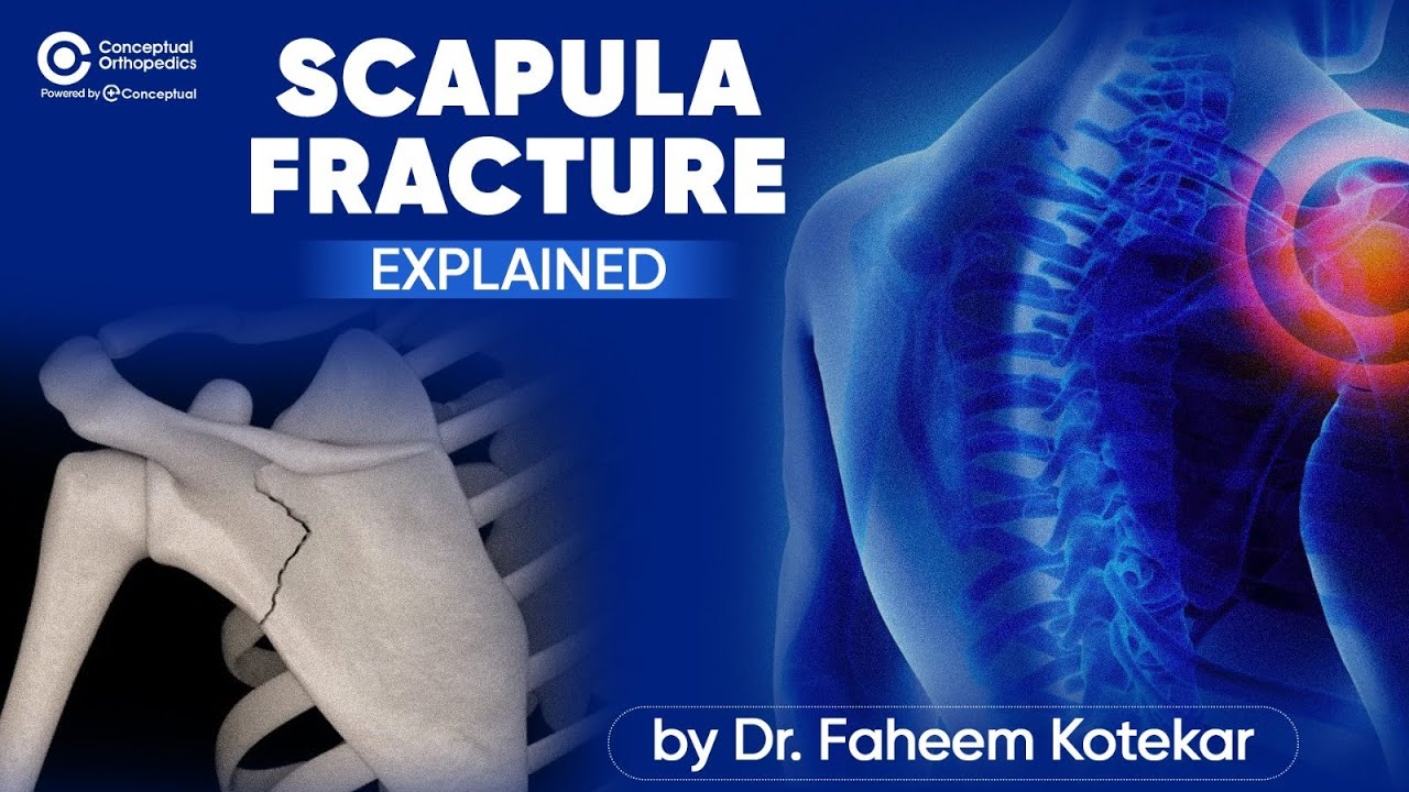 Scapula Fracture Explained | Dr. Faheem Kotekar