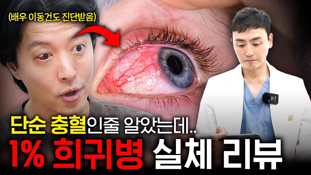 눈 충혈? 절대 가볍게 보면 안 됩니다&hellip;미우새 이동건도 진단받은 희귀병의 정체는?