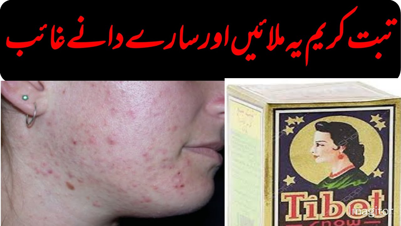 Tibet Cream Acne Treatment by Herbal Home Remedies