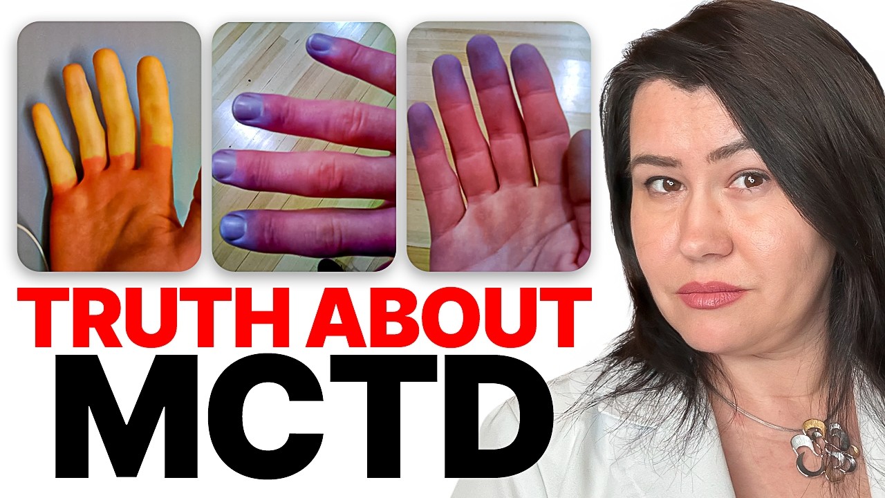 MCTD Treatment EXPLAINED, and #1 Thing You MUST Know!