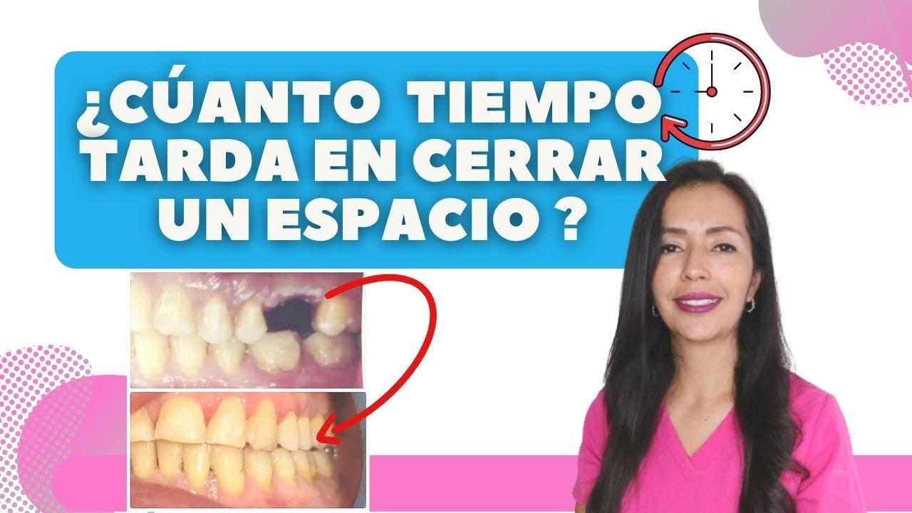 ¿Cuánto tiempo tarda en cerrar un espacio después de una extracción?.😳 Guía 2022