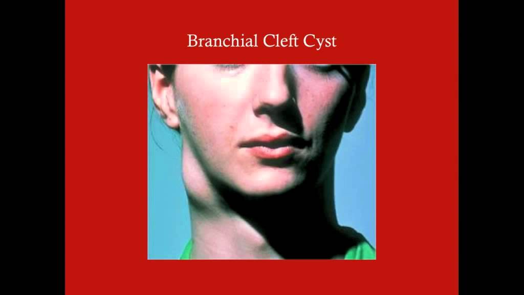 Congenital Neck Masses - CRASH! Medical Review Series