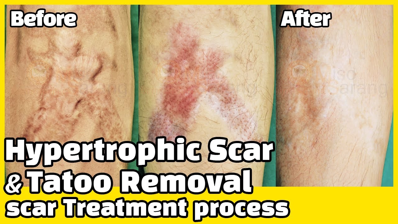 ［Scar clinic in korea］hypertrophic scar treatment process(#hypertrophic scar)(#tatoo removal)