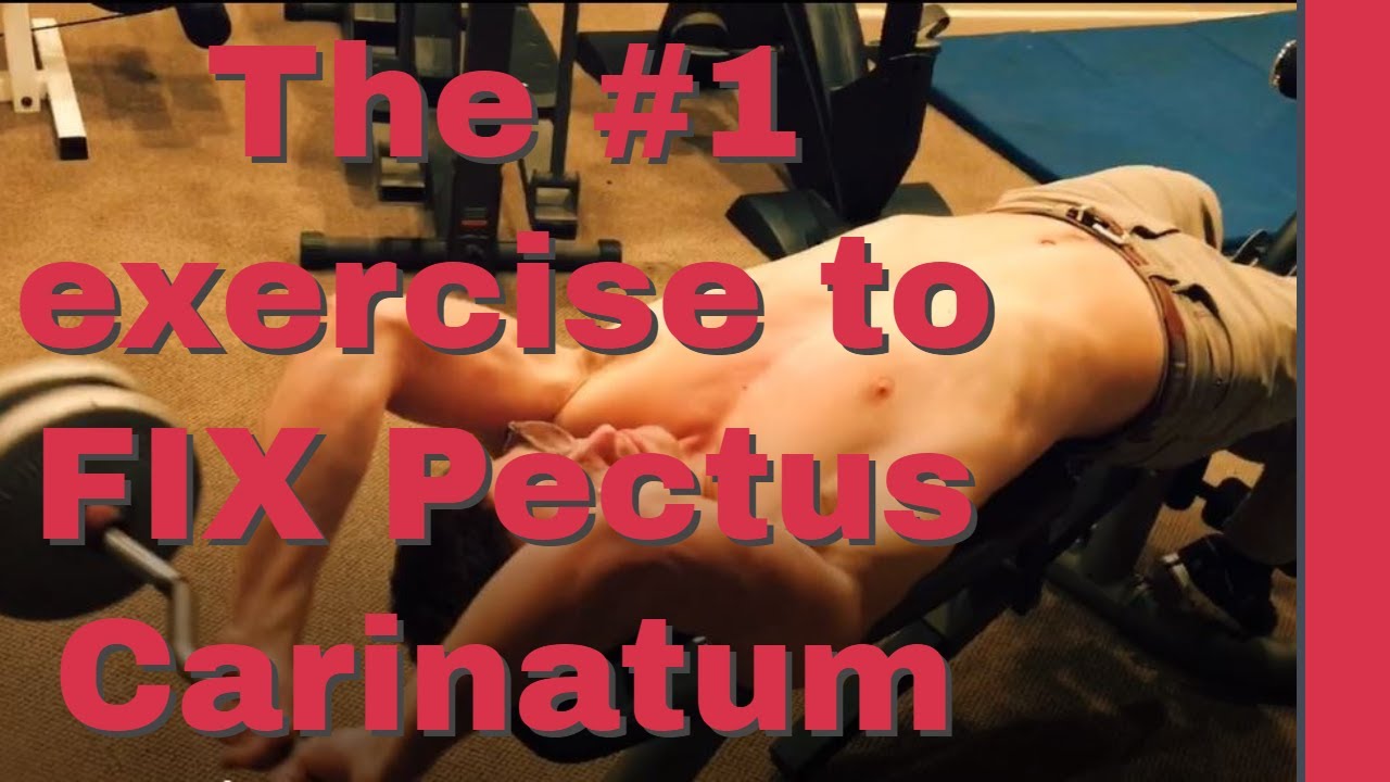 BEST EXERCISE FOR PECTUS CARINATUM