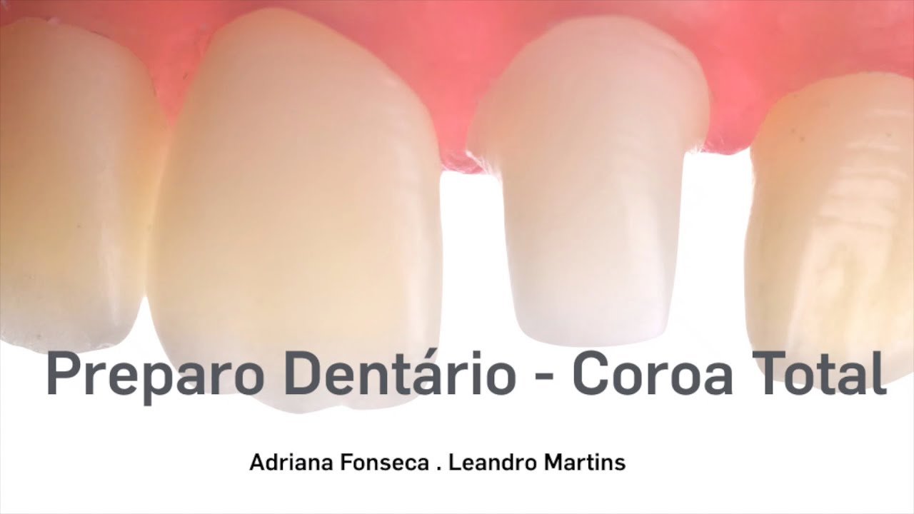 Preparo Dentário - Coroa Total Anterior