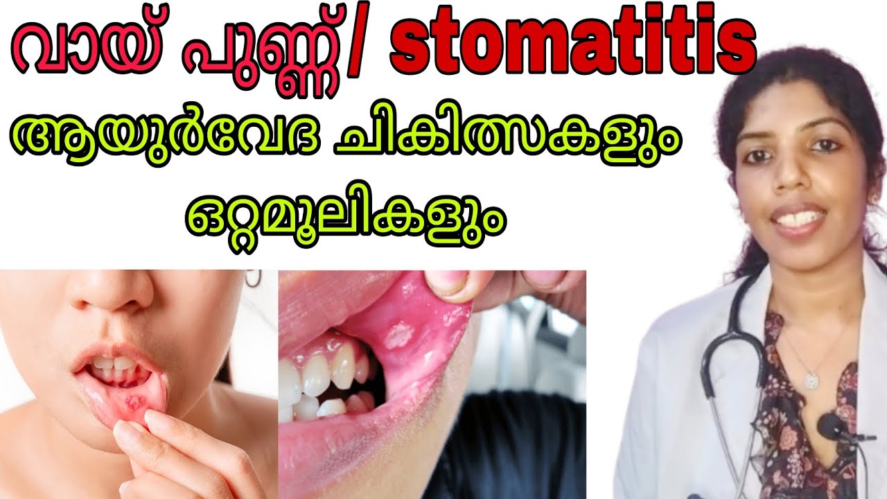വായ് പുന്നിനുള്ള ആയുർവേദ ചികിത്സകൾ#stomatitis#ayurvedadoctor#malayalam#viral#video