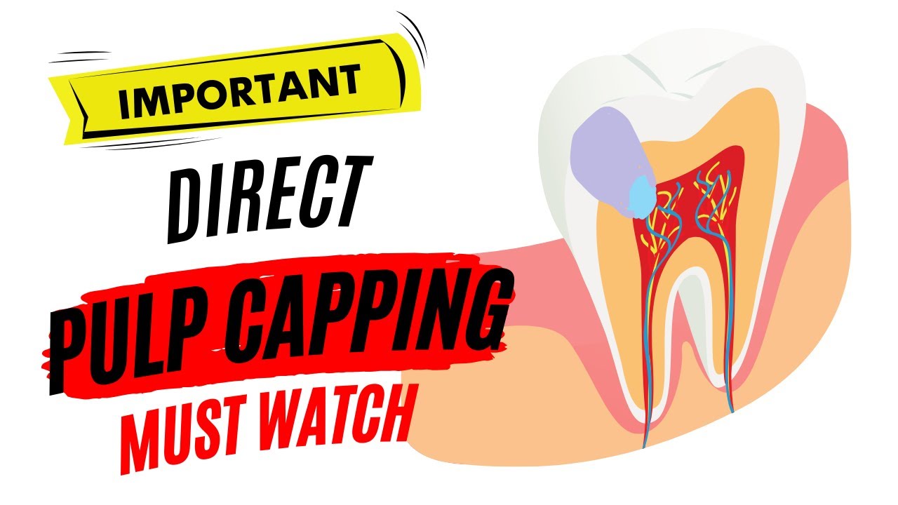 Direct Pulp Capping (DPC)