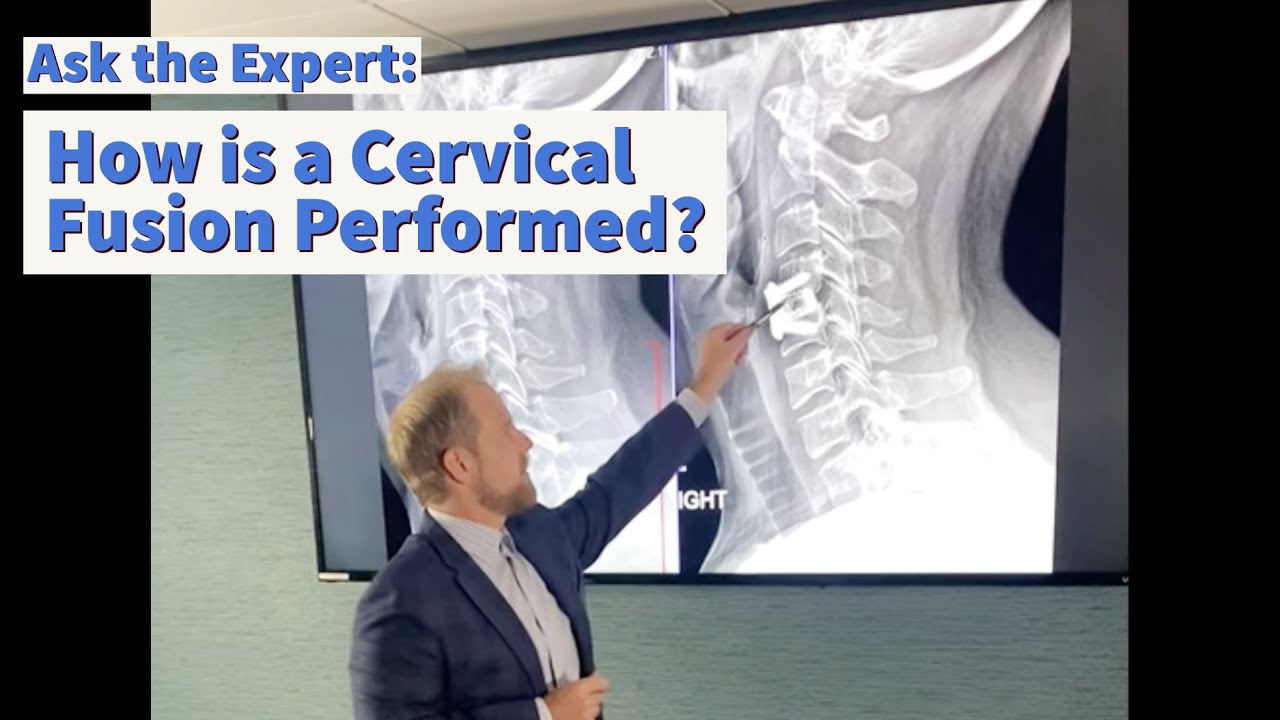 How is a Cervical Fusion Performed? Dr. Good Breaks Down Spine Fusion Surgery.