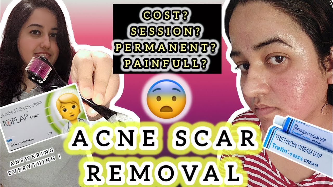 ACNE SCAR REMOVAL TREATMENT | DERMA ROLLER FOR ACNE SCAR👩‍⚕ #dermaroller #acnescar #acnescarremoval 