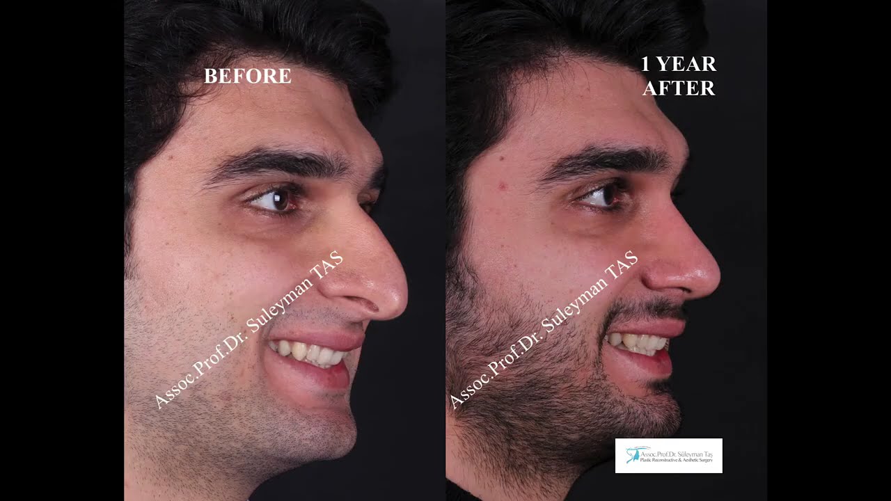 Male Rhinoplasty in Turkey