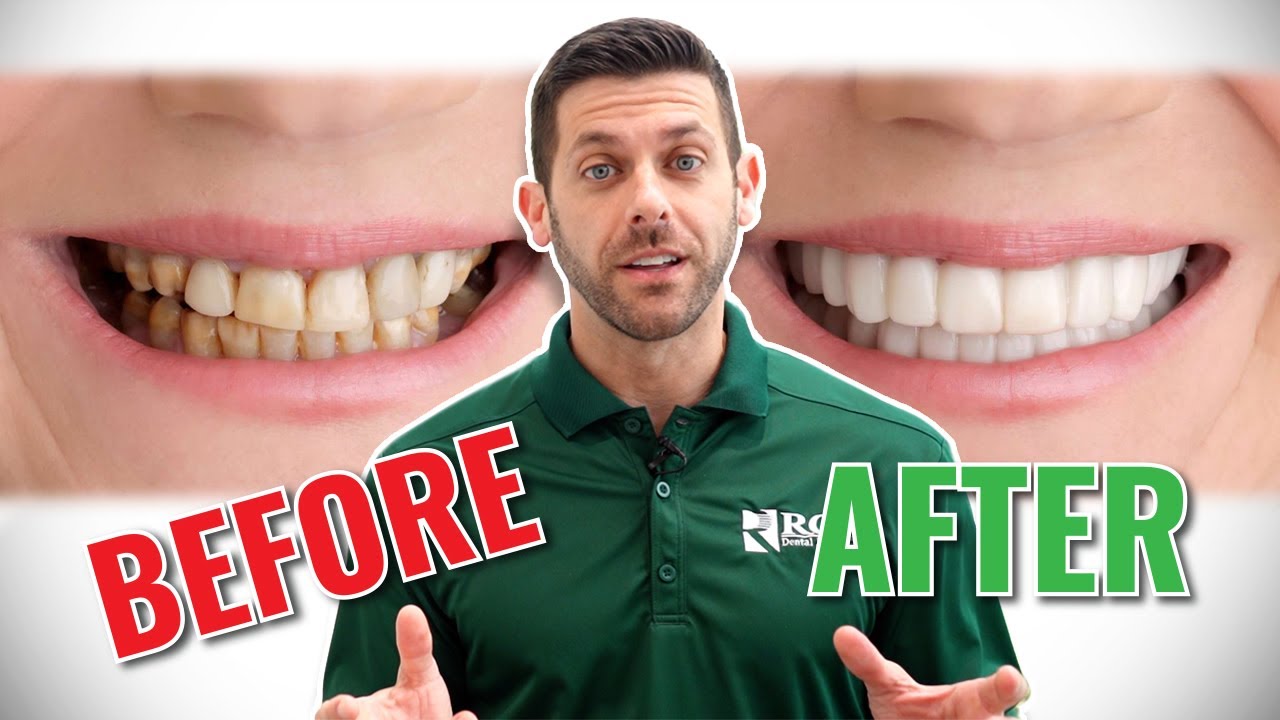 Snap-On Smile - ROE's Temporary Veneer Option for Dentists