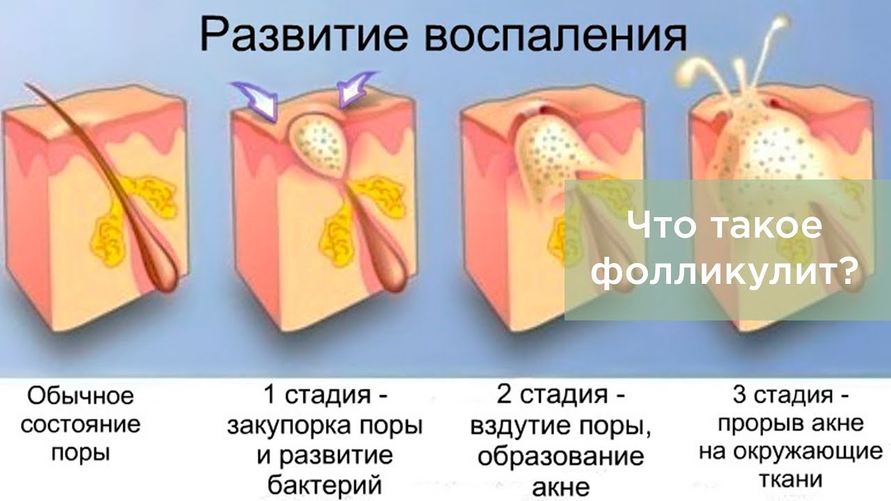 Что такое ФОЛЛИКУЛИТ