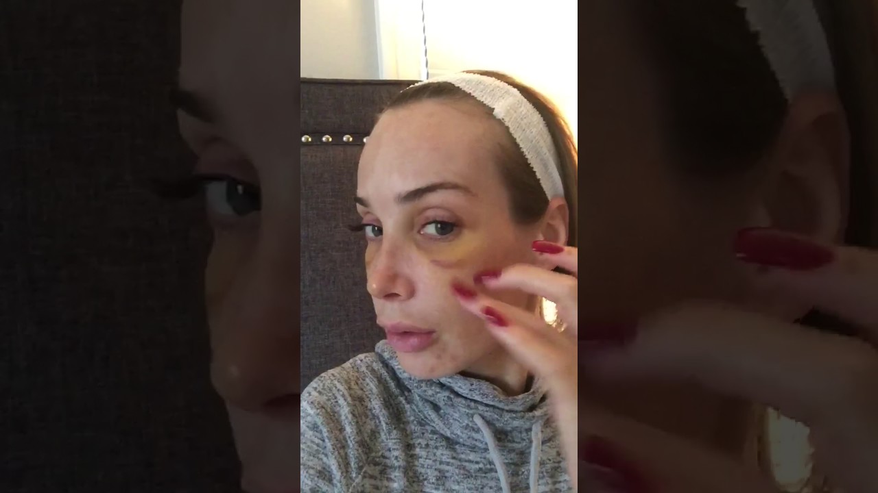 Patient Video Diary: Karin - The Reveal