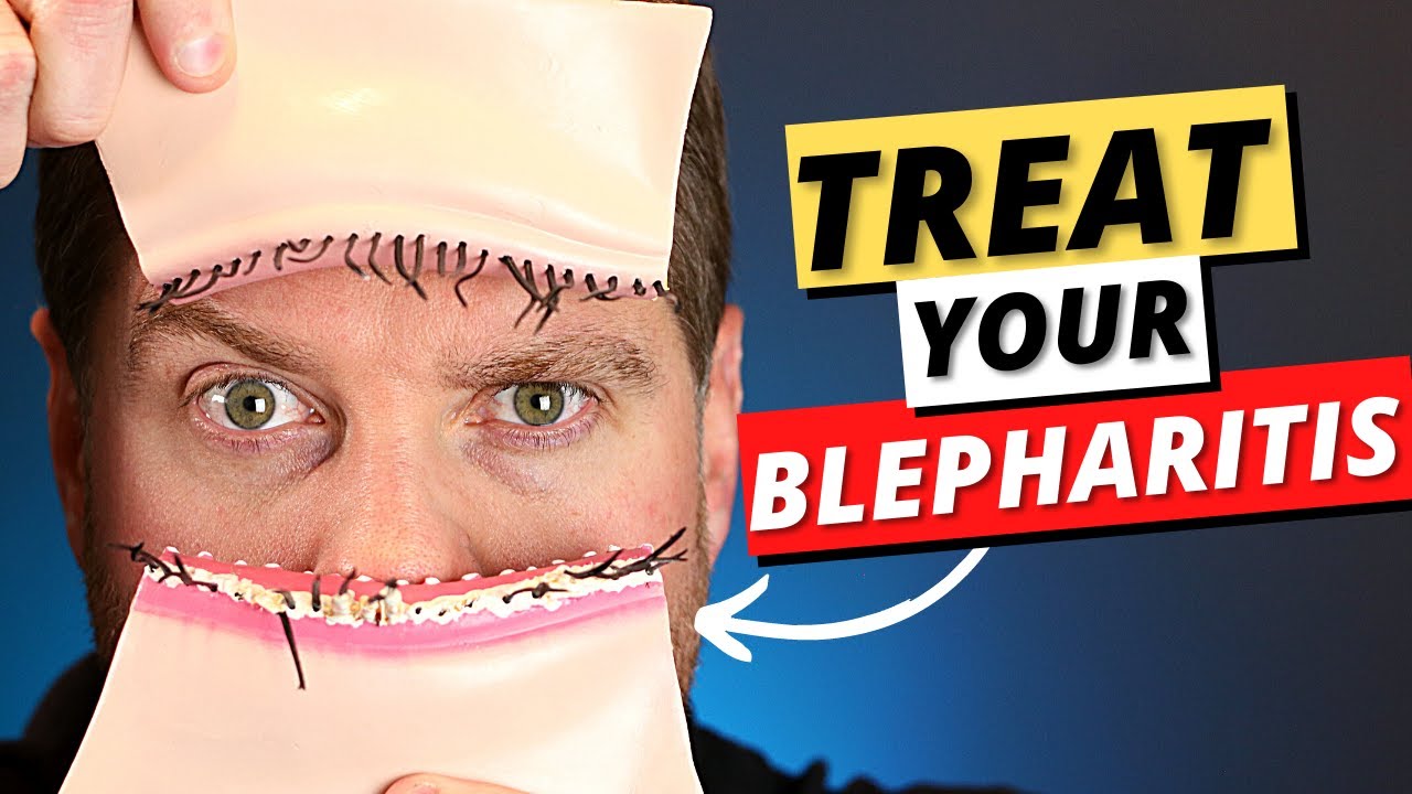 Blepharitis: Top 3 Treatments For Blepharitis Removal At Home