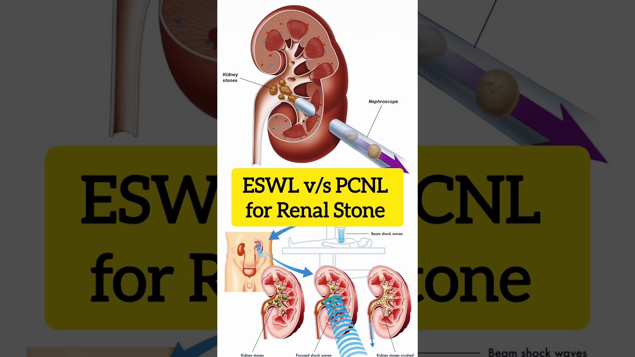 ESWL vs PCNL for renal stone #eswl #pcnl #renalstone #nephrology #urology