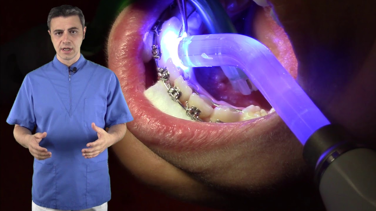 Contenzione: il retainer inferiore (video operativo)