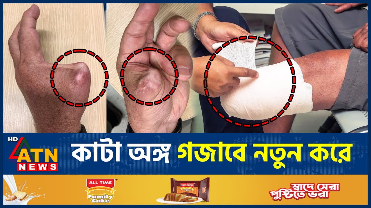 কা*টা অঙ্গ গজাবে নতুন করে, চিকিৎসা ক্ষেত্রে চীনের যুগান্তকারী সফলতা | China Treatment | ATN News