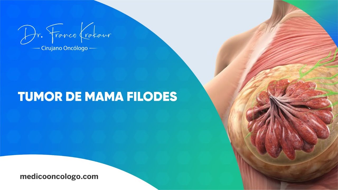 Tumor De Mama Filodes | Dr. Franco Krakaur | Cirujano Oncólogo