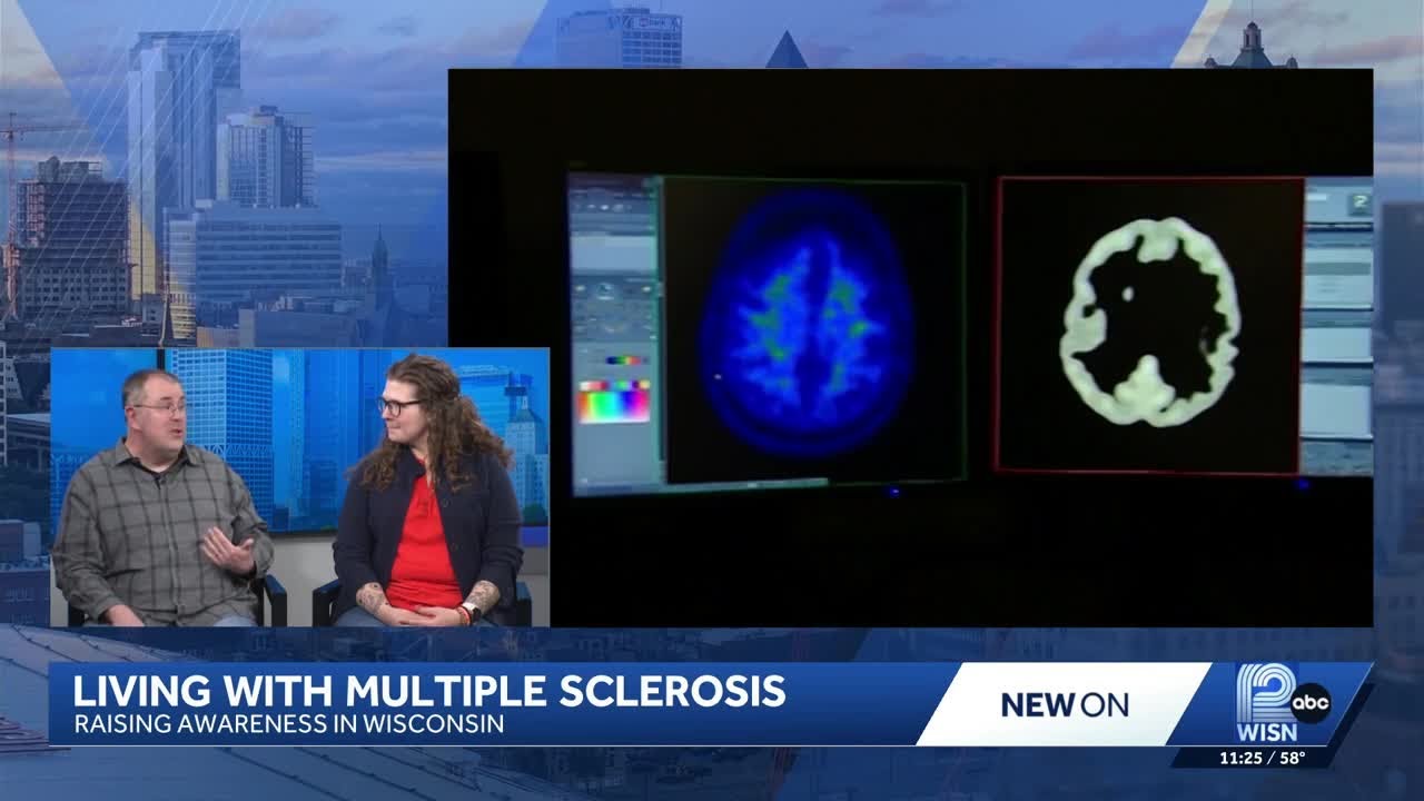 Living with multiple sclerosis