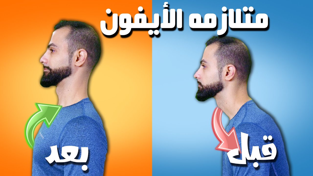 متلازمه الايفون || تحدب الظهر ألم الرقبه والأكتاف (الكايفوس) upper cross syndrom
