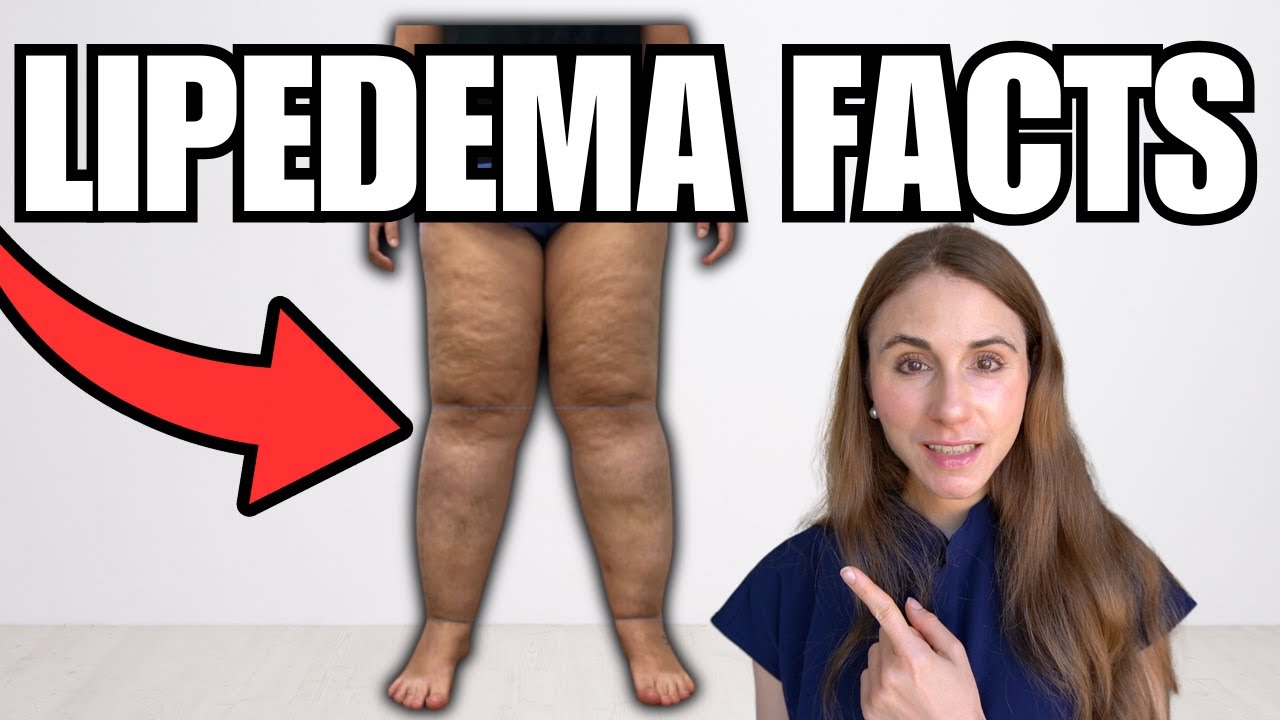 Przyczyny i leczenie lipedema wyjaśnione