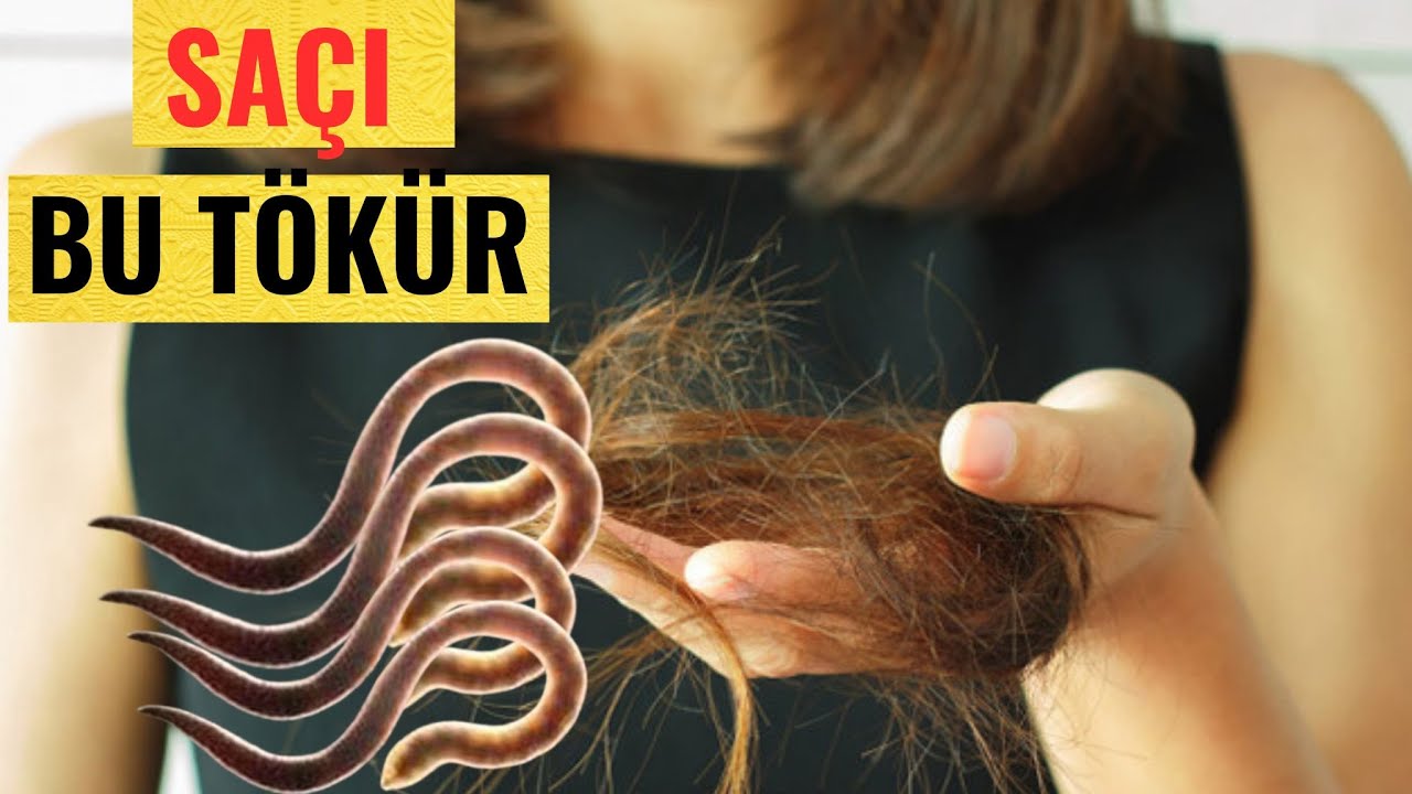 Sən demə saçımız bağırsaqdakı bu qurdlara görə  tökülürmüş