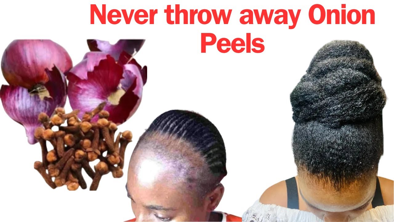 The Viral Cloves and Onion Peels Water For Extreme Hair Growth. The Secret No One Tells