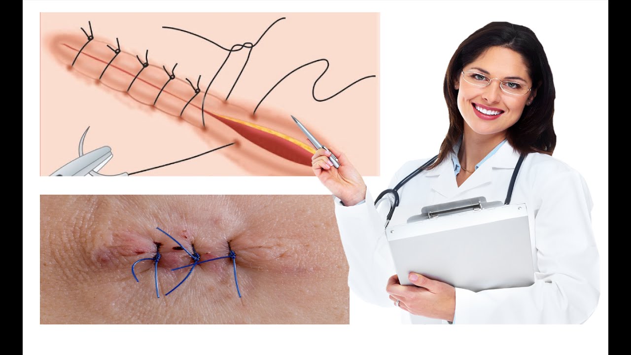 les différents types et techniques de sutures