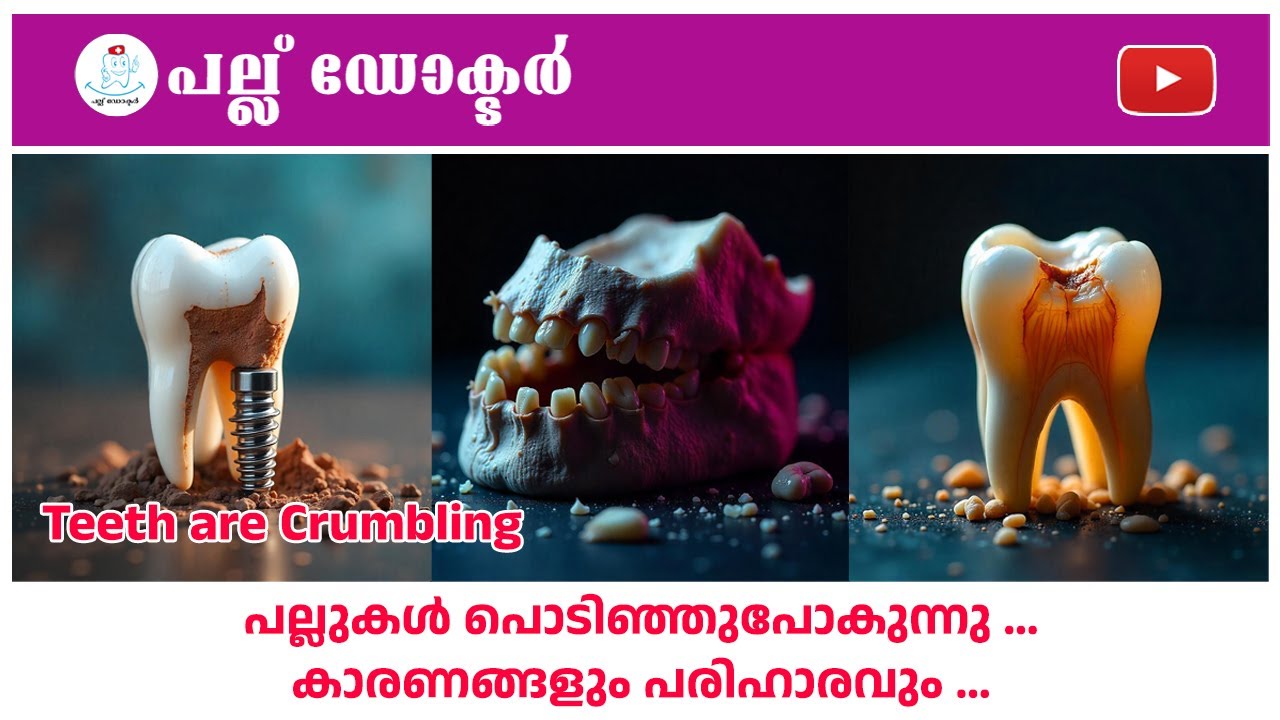 പല്ലുകൾ പൊടിഞ്ഞുപോകുന്നു ...കാരണങ്ങളും പരിഹാരവും/Teeth Are Crumbling? Here’s What You Need to Know!