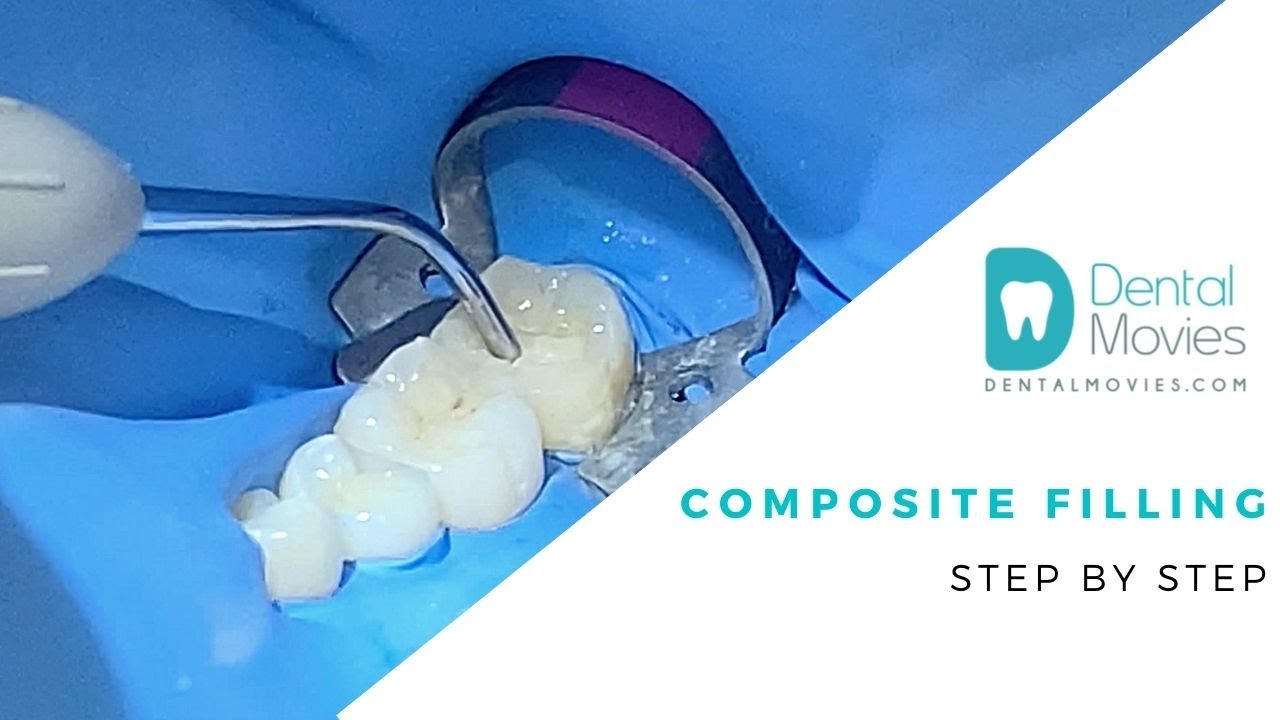Composite filling - step by step 🦷📚