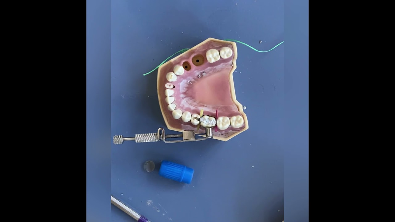 Black 2 kavite (MOD) amalgam dolgu/ Clas 2 amalgam filling(silver filling)