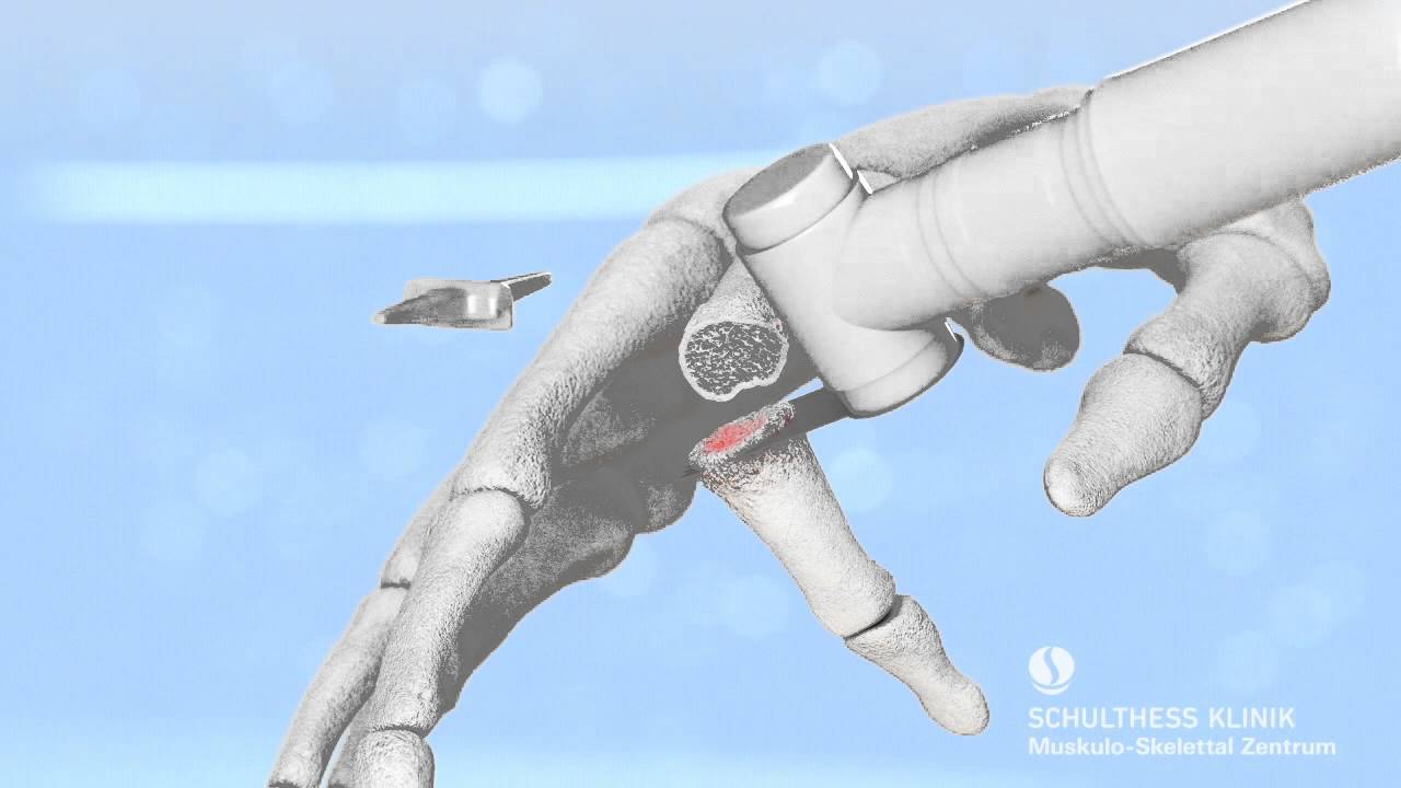 &laquo;Fingergelenksarthrose - Silikon Kunstgelenk&raquo; - Schulthess Klinik