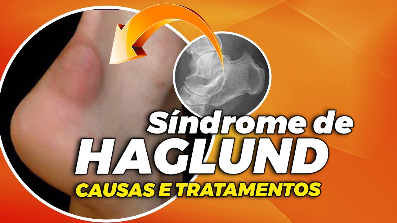 Deformidade Haglund de no calcanhar: Prevenção e Tratamento