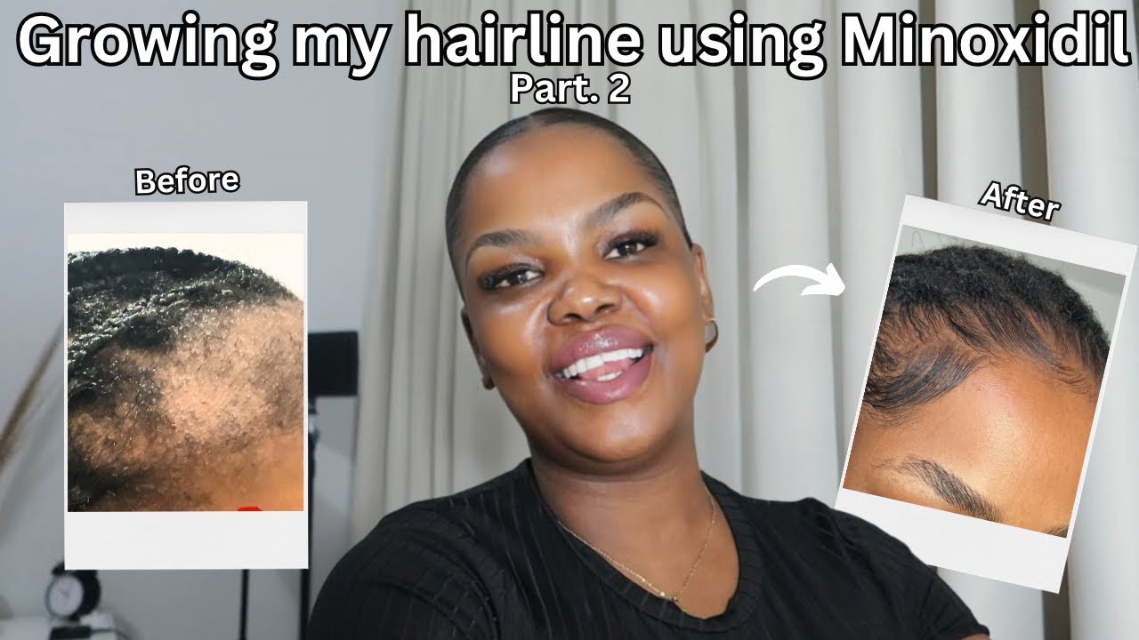 How I Grew My Edges Using Minoxidil | Part 2