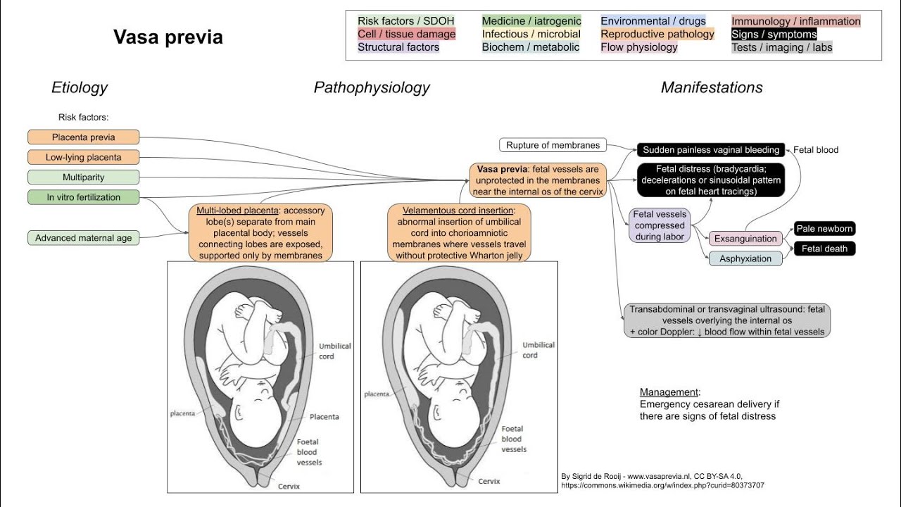 Vasa previa (mechanism of disease)
