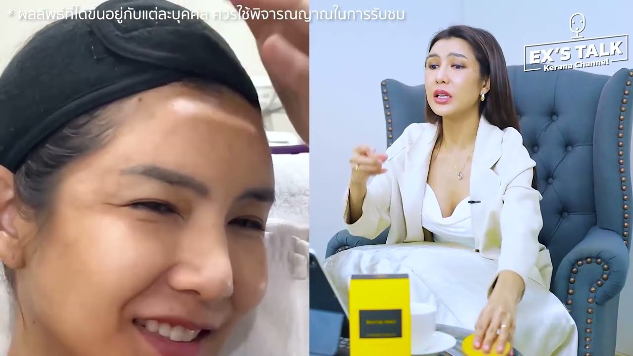 EndoliftX เข้าแก้ไขปัญหาพังผืดดึงรั้งจากการใช้ไหมและสารเติมเต็มซำๆบนใบหน้า  #Ex's Talk Ep3
