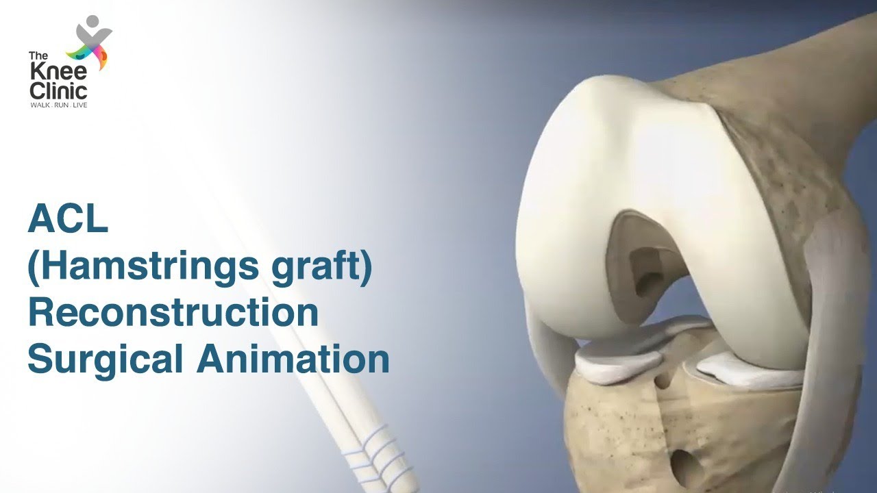 Know more about ACL (Hamstring graft) Reconstruction Surgical Animation