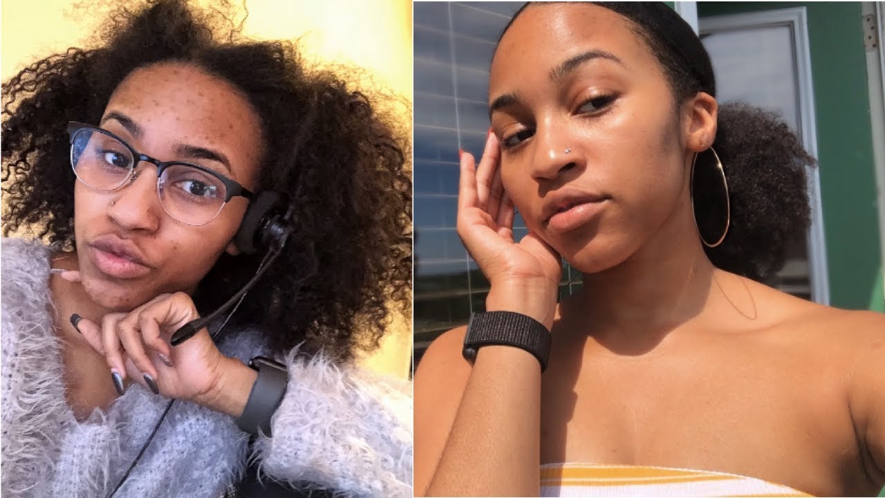 Acne.org Before and After inspired Routine