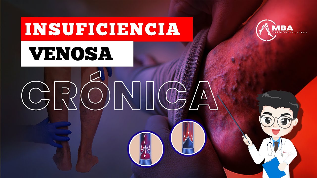 INSUFICIENCIA VENOSA -  HABLEMOS FUERTE Y CLARO | EXPLICACIÓN PASO A PASO SOBRE 