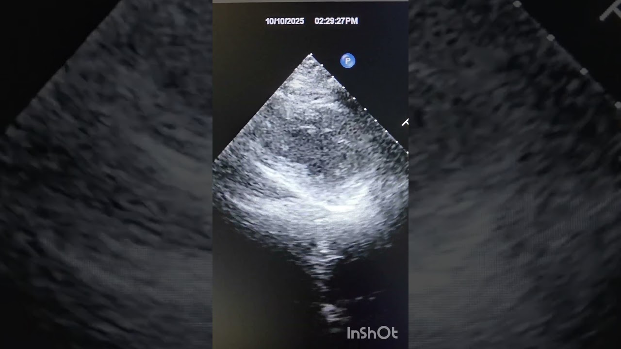 ANTERO-SEPTAL MYOCARDIAL INFARCTION