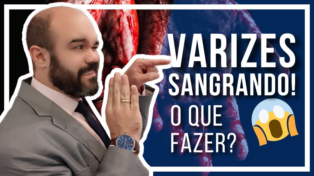 🔴 VARIZES SANGRANDO!! O que voc&ecirc; deve fazer para evitar o pior? [OBRIGAT&Oacute;RIO PARA QUEM TEM VARIZES]