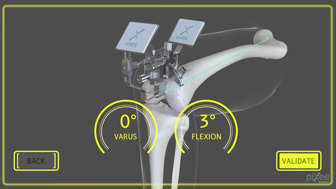 #nevigation #pixee# surgery #knee #kneepain #viralvideo