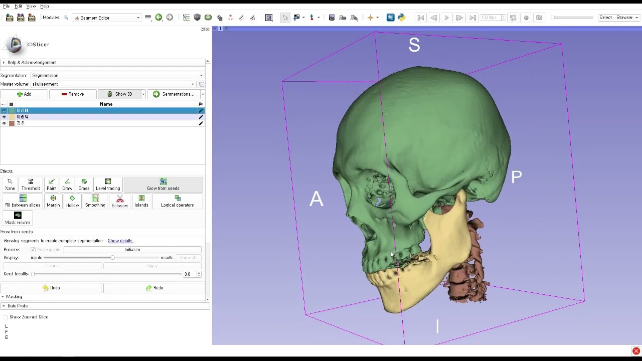 3D Slicer Tutorial_Skull