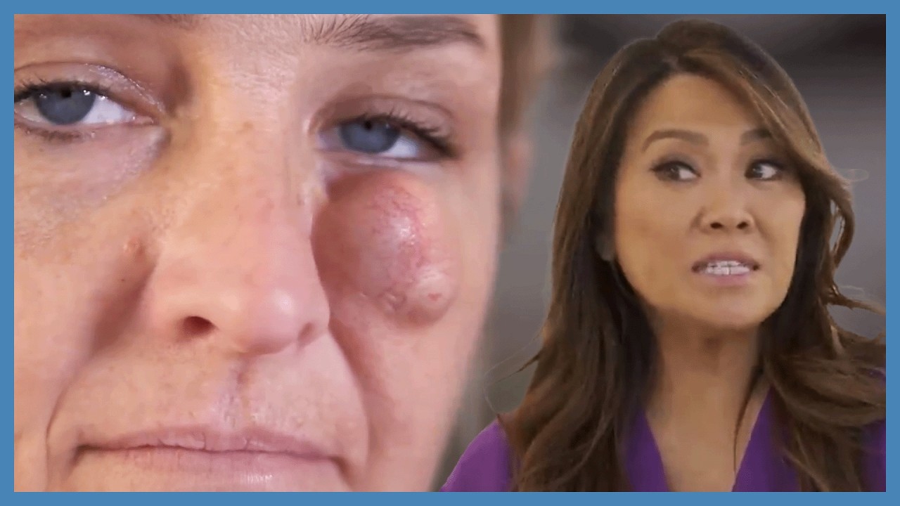 Dr. Lee Removes Vision-Blocking Cyst | Dr Pimple Popper