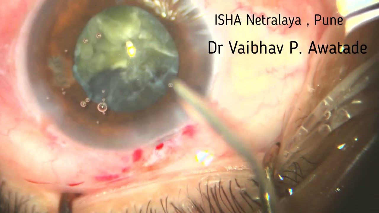 Intraop Zonular Dehisance , Managed with CTR & Anterior Vitrectomy , Triphobic IOL , 13/02/26